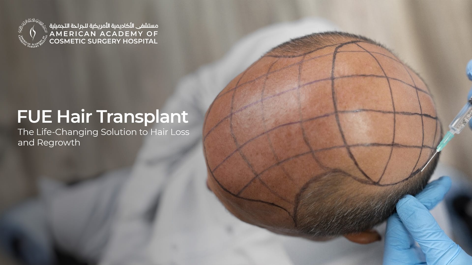 American Academy of Cosmetic Surgery Hospital | زراعة الشعر بتقنية FUE: الحل الذي يغير الحياة لمشكلة تساقط الشعر وإعادة النمو