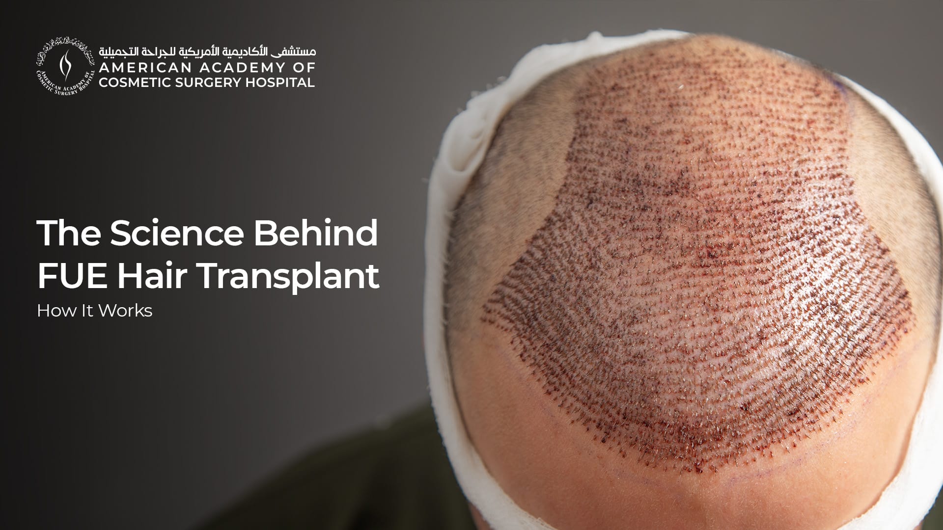 American Academy of Cosmetic Surgery Hospital | العلم وراء زراعة الشعر بتقنية FUE: كيف تعمل American Academy of Cosmetic Surgery Hospital | العلم وراء زراعة الشعر بتقنية FUE: كيف تعمل
