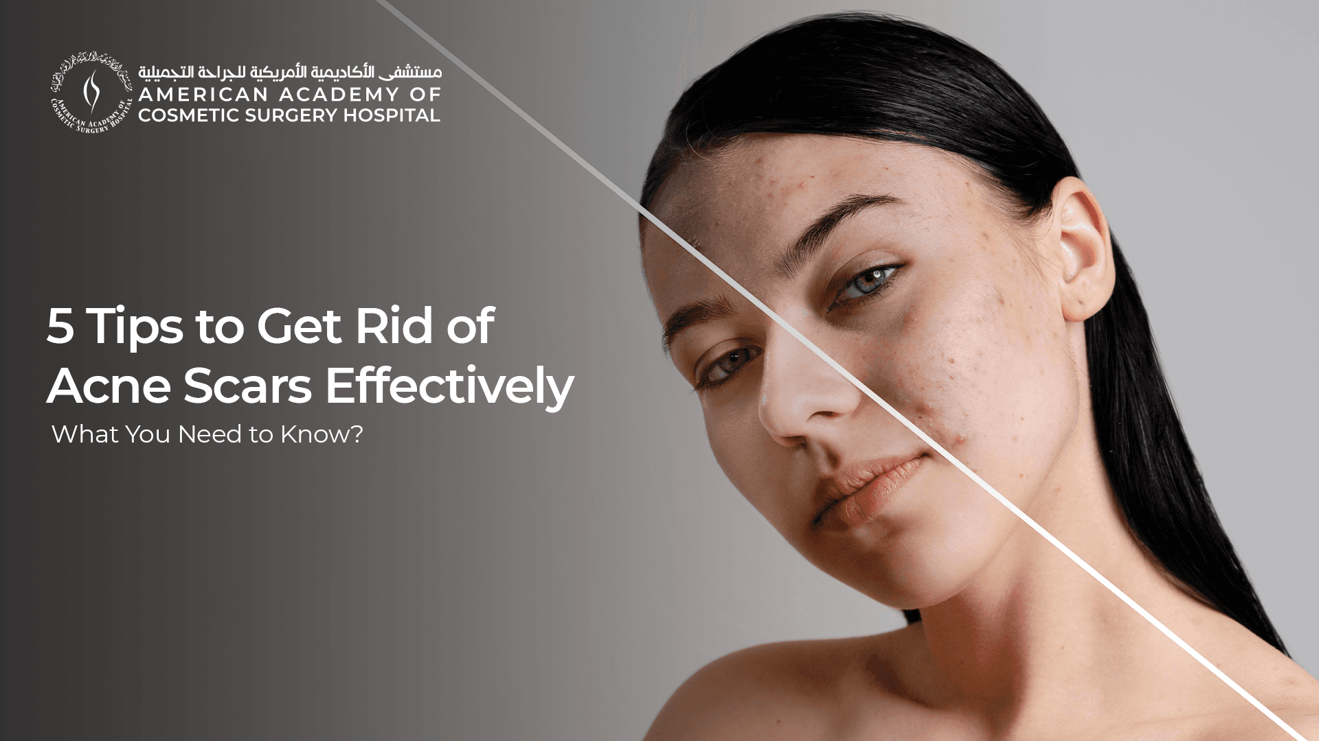 American Academy of Cosmetic Surgery Hospital | 5 Tips to Get Rid of Acne Scars Effectively: What You Need To Know American Academy of Cosmetic Surgery Hospital | 5 Tips to Get Rid of Acne Scars Effectively: What You Need To Know