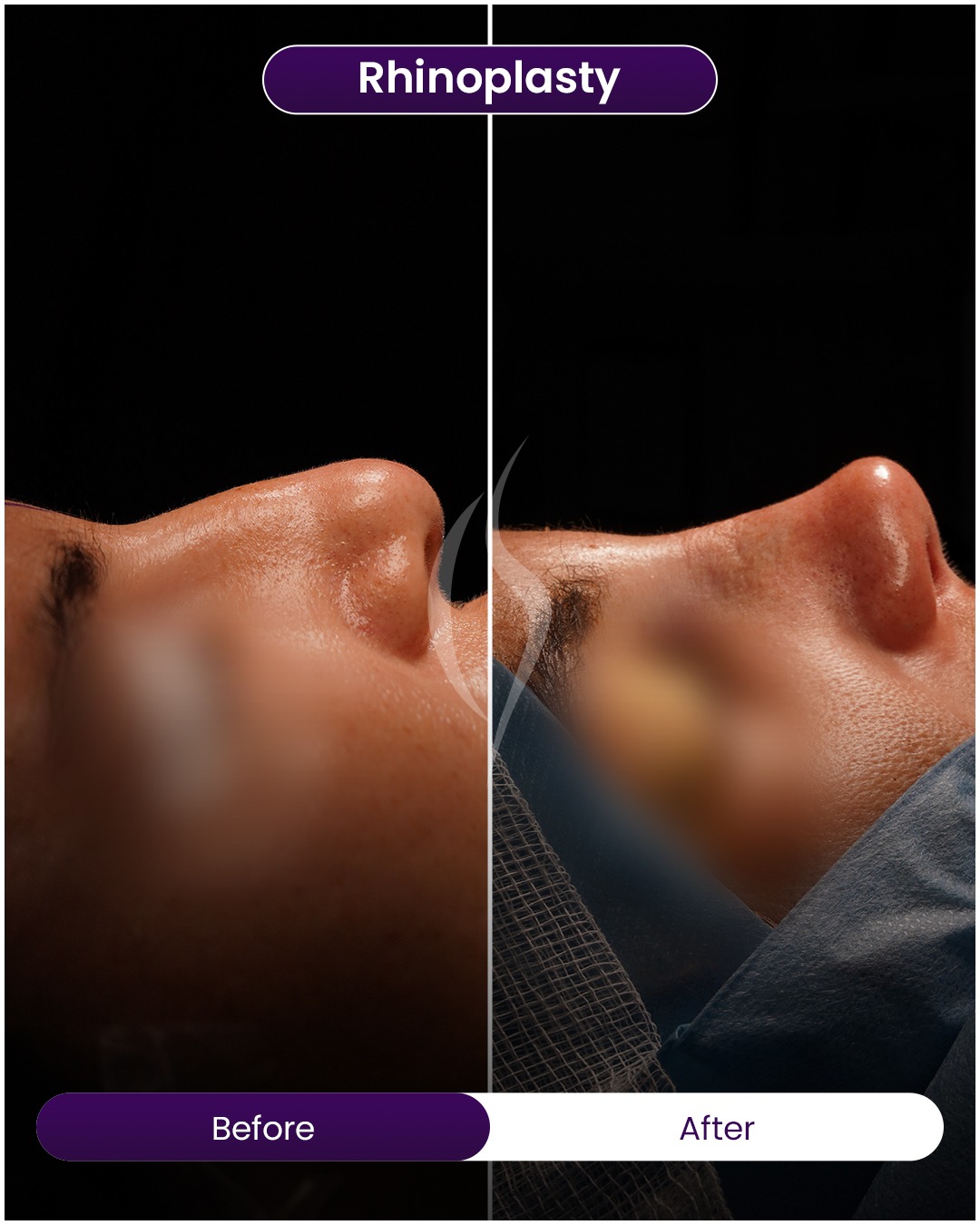 American Academy of Cosmetic Surgery Hospital | Rhinoplasty PPC