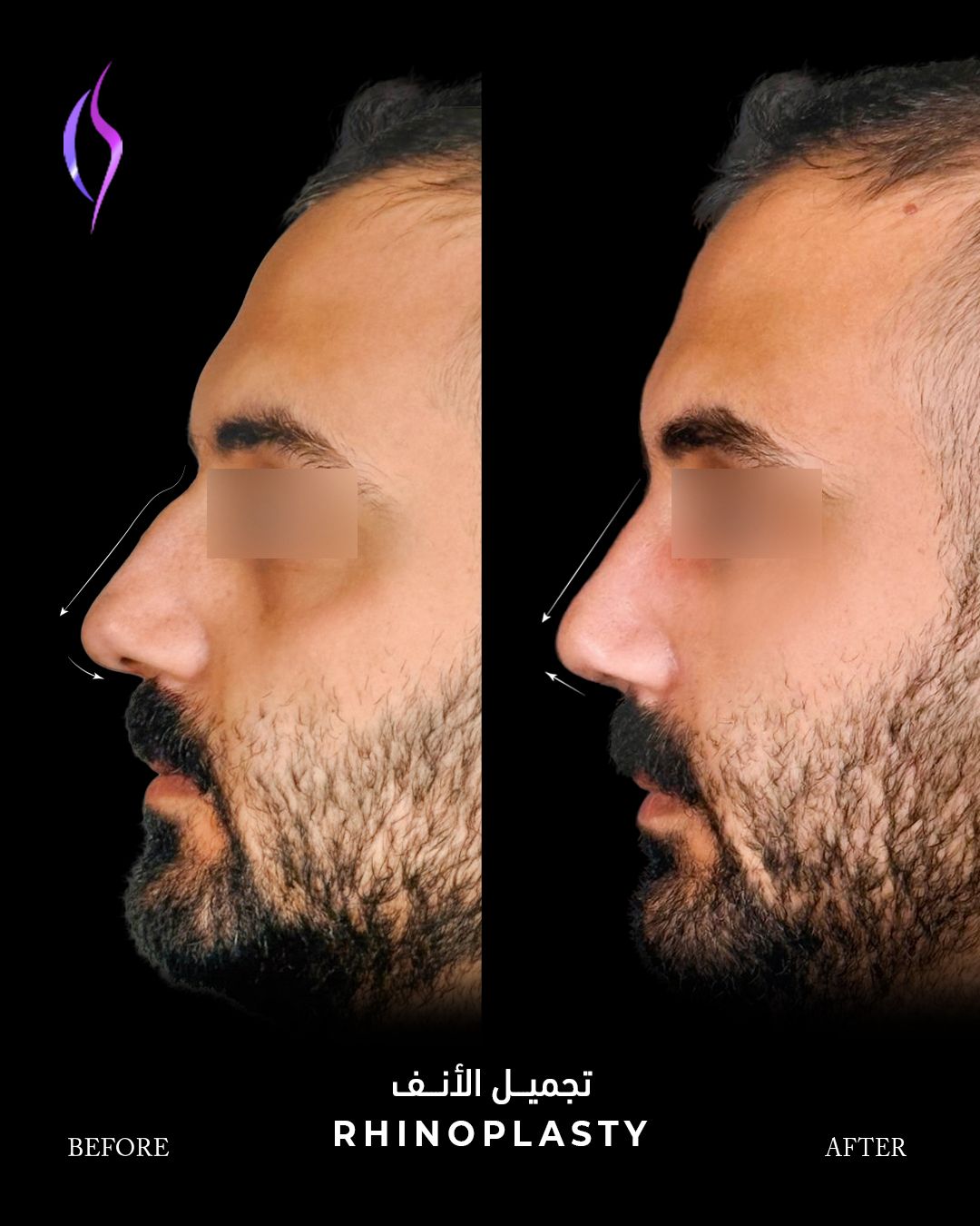 American Academy of Cosmetic Surgery Hospital | Rhinoplasty PPC