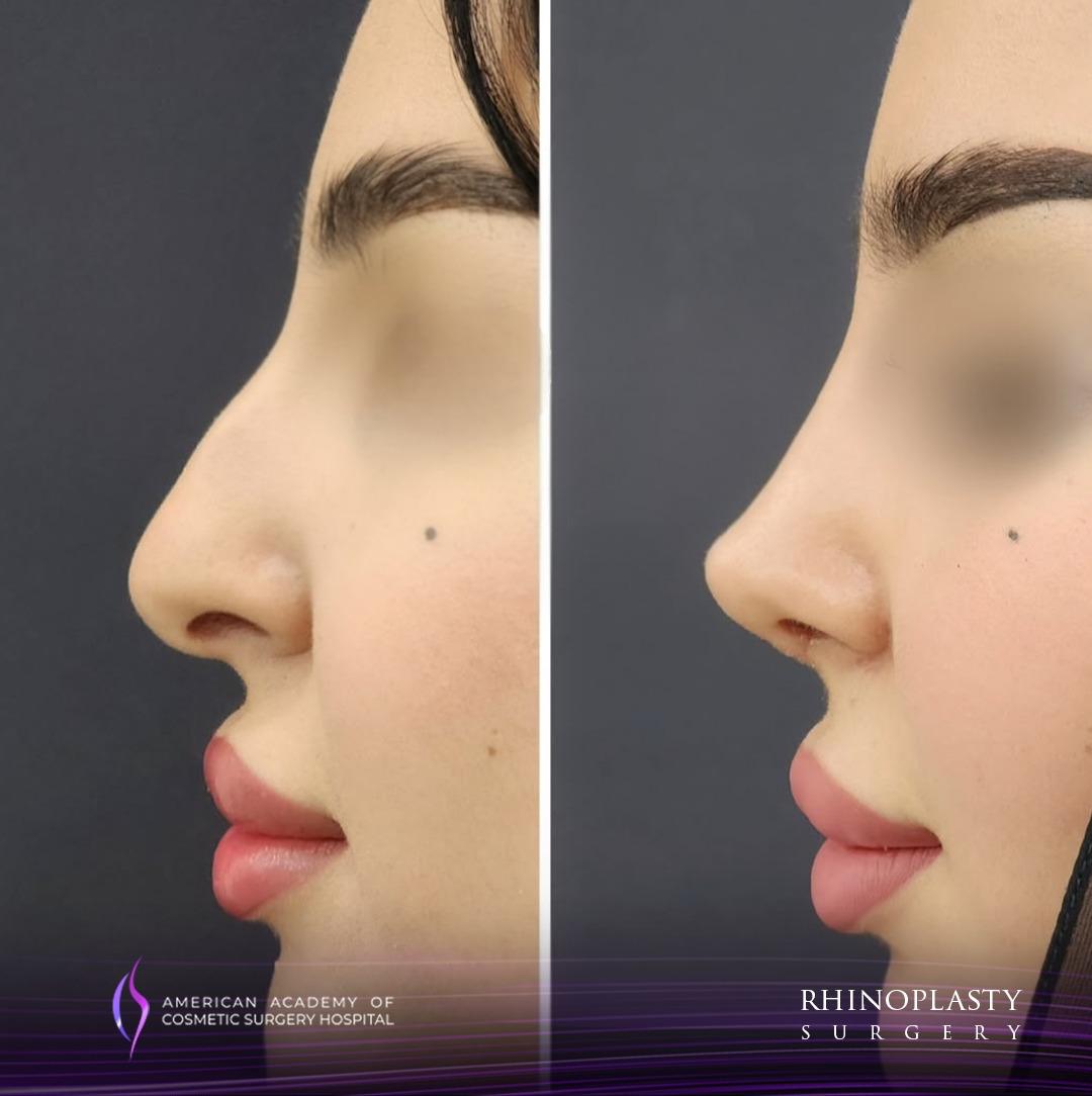 American Academy of Cosmetic Surgery Hospital | Rhinoplasty PPC