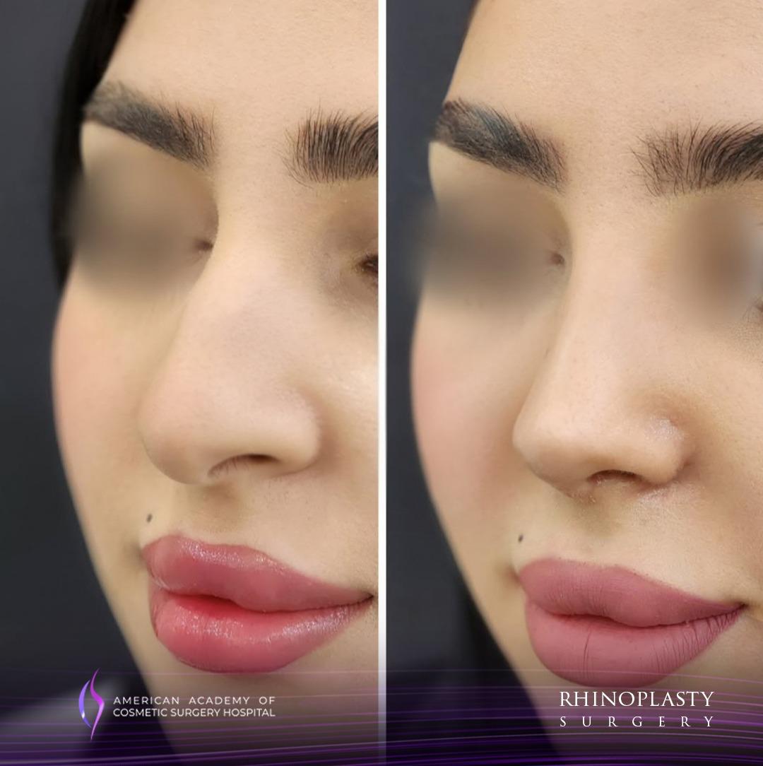 American Academy of Cosmetic Surgery Hospital | Rhinoplasty PPC