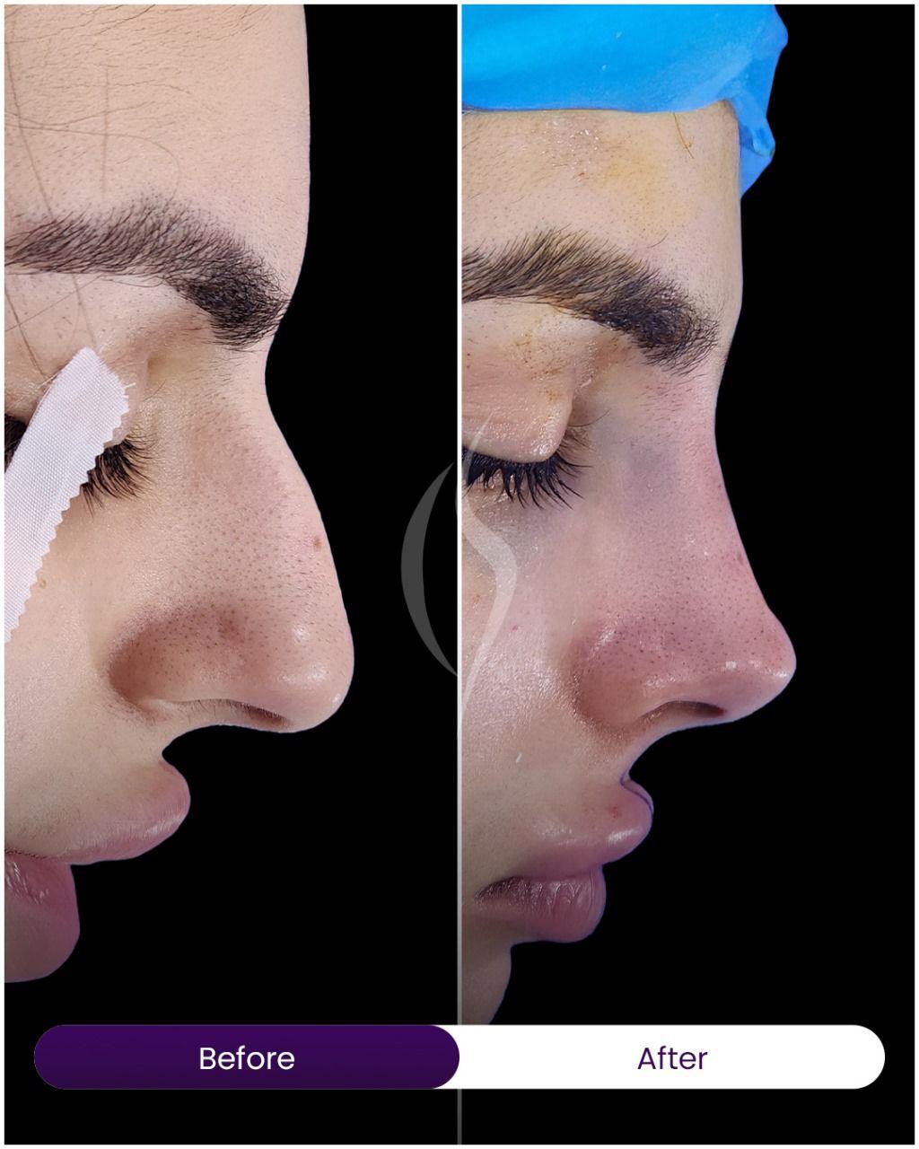American Academy of Cosmetic Surgery Hospital | Rhinoplasty PPC