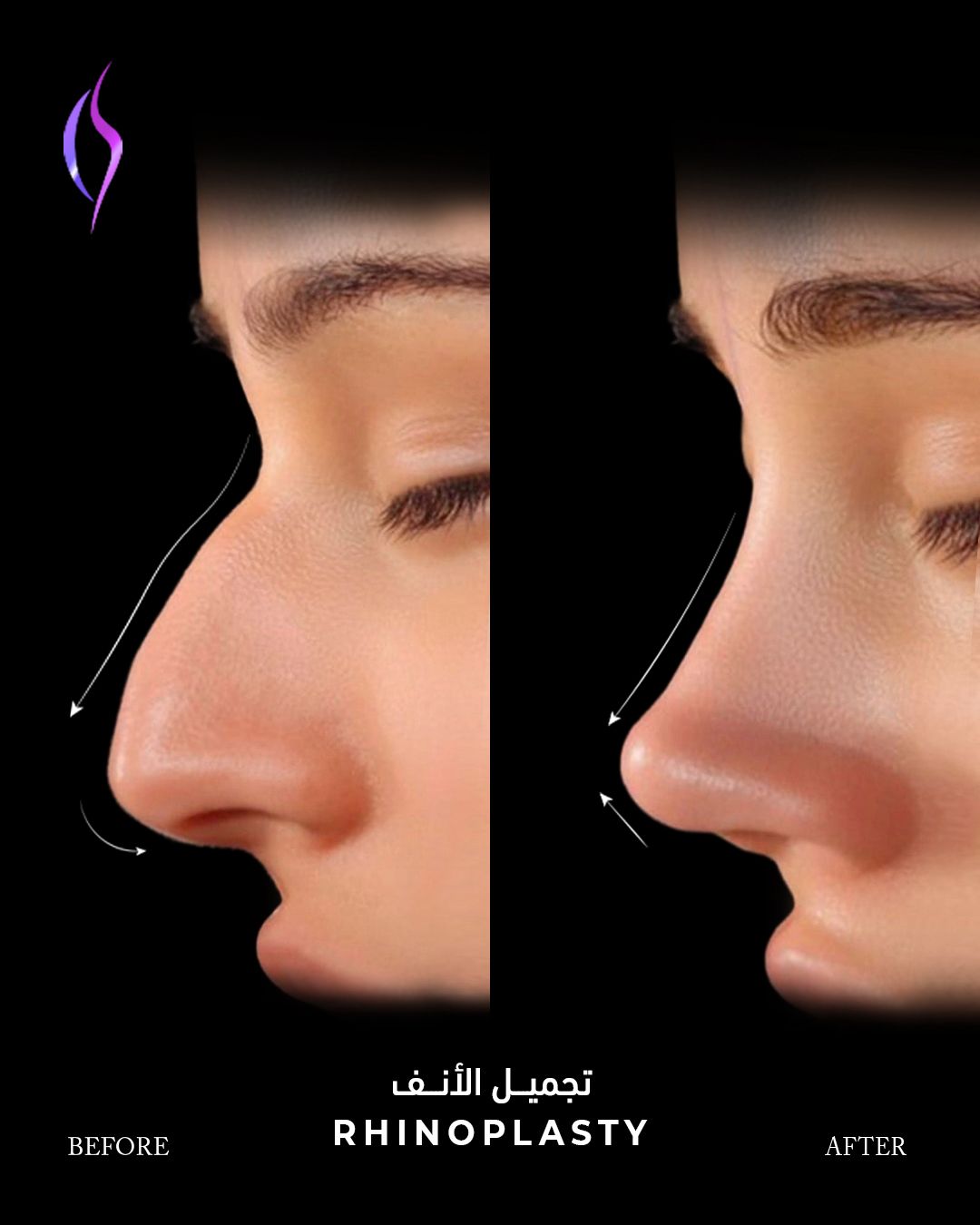 American Academy of Cosmetic Surgery Hospital | Rhinoplasty PPC
